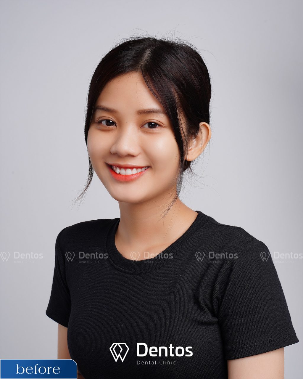 Bọc răng sứ giúp khách hàng có thần thái tự tin, sang trọng